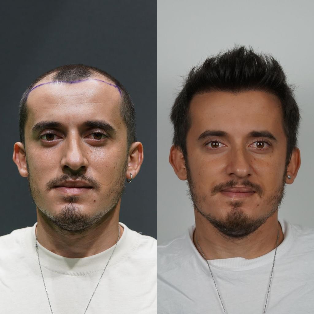 prima e dopo trapianto capelli 18